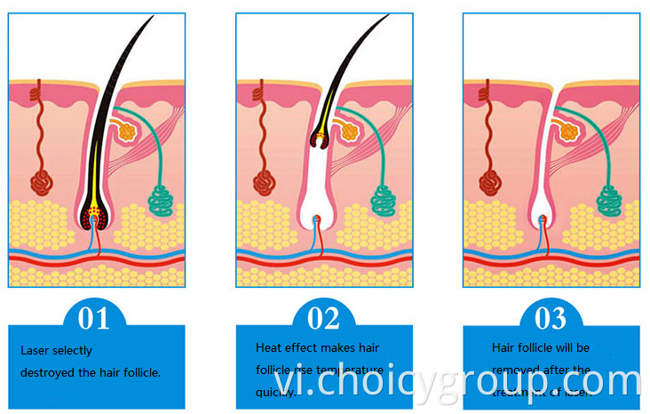 Diode Laser Hair Removal Beauty Equipment